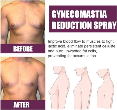 gynecomastia reduction spray